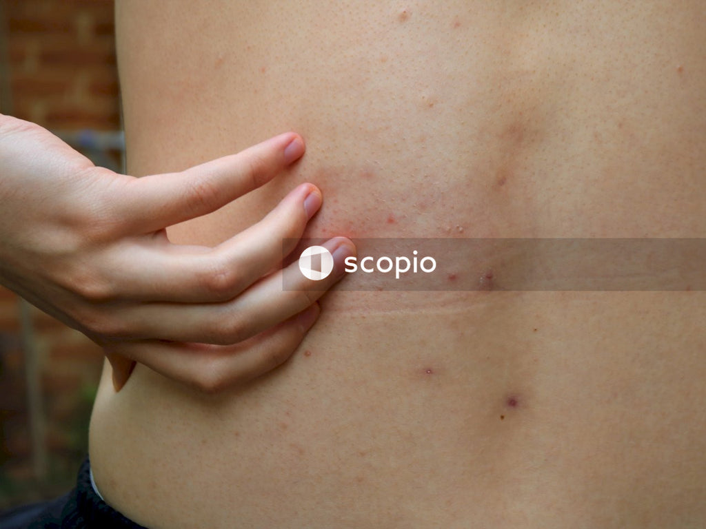 Hand scratches back covered with pimples